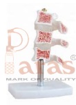 Vertebral Osteoporosis
Model