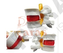 Disc Prolapse Simulator