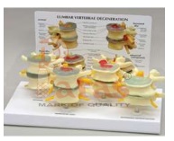 Lumbar
Vertrbrae
Degeneration Model