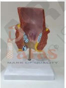 Diseased Rectum Model