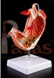 Diseased Stomach Model
