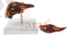Diseased Liver Model (Small)