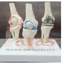 Stage Arthritis Knee Model
with Implant