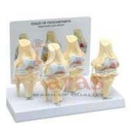 Stages Knee Arthritis
Model
