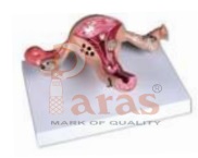 Diseased Uterus Model