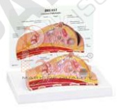 Diseased Breast
Model